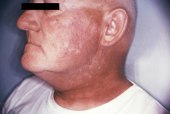 CDC/Robert E. Sumpter