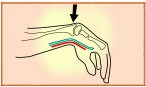 Illustration of flexed wrist