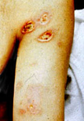 Quemaduras del Arco o del Destello