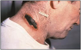 Infection with BA can cause cutaneous anthrax. Lesions, like on this patient’s neck, are marked by a typical black eschar.