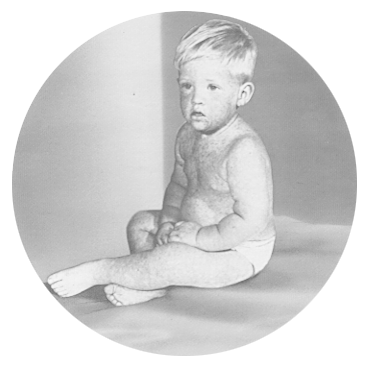 A child with measles | Photo Credit: U.S. National Library of Medicine