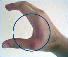 Figure 2 Wide handle spans and finger positions require additional force exertion to perform a task.